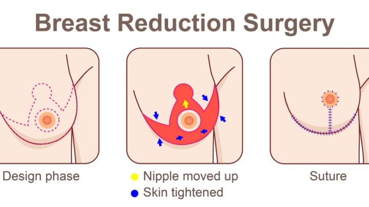 Breast reduction treatment