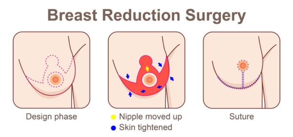 Breast reduction treatment